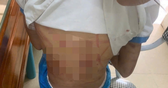 Bé gái lớp 5 ở Hà Tĩnh nghi bị bạo hành, cơ thể chằng chịt vết thương