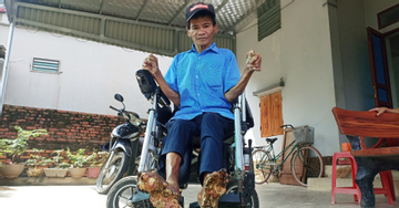 Cuộc sống của người đàn ông mắc bệnh 'người cây' hiếm gặp ở Ninh Bình