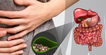 Đi khám vì đau bụng, bác sĩ lấy ra 30 viên sỏi mật trong người bệnh nhân 31 tuổi ở Phú Thọ