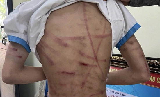 Bé gái 10 tuổi bị cha dượng bạo hành ở Hà Tĩnh được ra viện