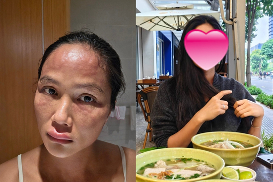 Tình trạng hiện tại của H'Hen Niê sau khi bị sưng phù mặt đến biến dạng