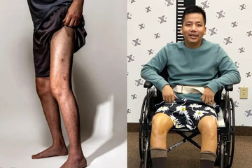 Bước đi tập tễnh, di chuyển không vững của Khoa Pug sau 2 lần chi tiền tỷ kéo chân