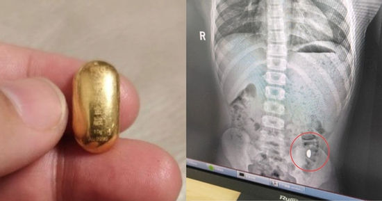 Con trai nuốt miếng vàng của mẹ vào bụng và cái kết