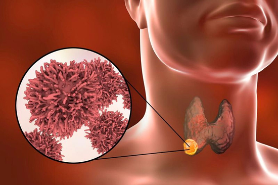 Lo lắng nhân giáp biến đổi ung thư? Cảnh giác với 4 triệu chứng cơ thể sau đây