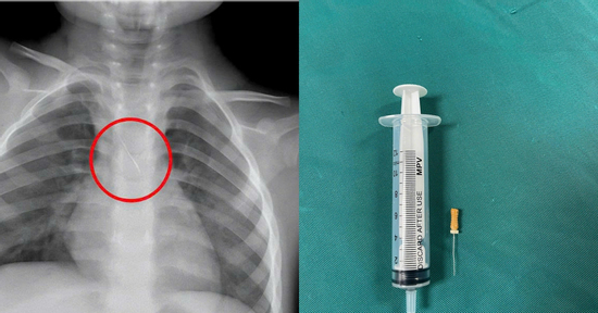 Bé 3 tuổi ở Quảng Trị bị kim chọc tủy kẹt trong đường thở