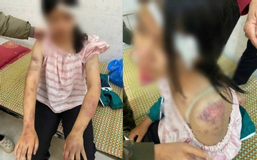 Bé gái 13 tuổi bị bà nội và hai người ông tra khảo, đánh đập dã man vì nghi trộm tiền