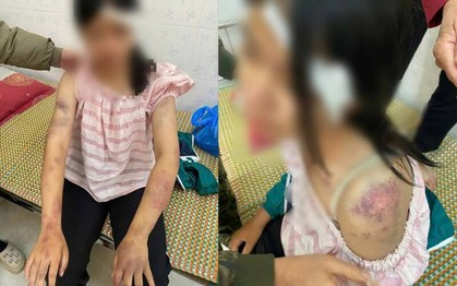 Bé gái 13 tuổi bị bà nội và hai người ông tra khảo, đánh đập dã man vì nghi trộm tiền