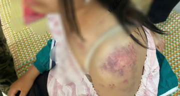 Sức khỏe bé gái bị bà nội và 2 người đàn ông bạo hành đến bầm tím khắp cơ thể