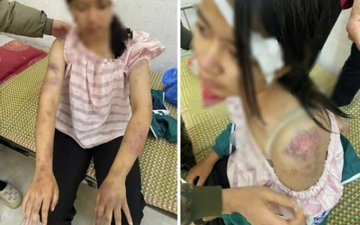 Hoàn cảnh éo le của bé gái 13 tuổi bị bà nội và hai người đàn ông tra khảo, đánh đập