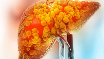 5 cách vận động 'đánh bay' gan nhiễm mỡ, đừng bỏ lỡ!