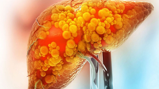 5 cách vận động 'đánh bay' gan nhiễm mỡ, đừng bỏ lỡ!