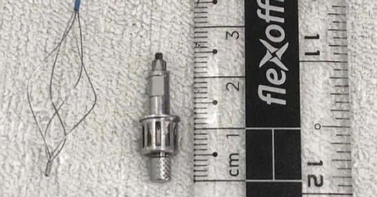 Người đàn ông bị dụng cụ nha khoa rơi vào phổi khi làm răng