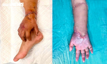 Bàn tay đứt lìa của mẹ bầu được nối lại sau thời gian 'nuôi' ở chân