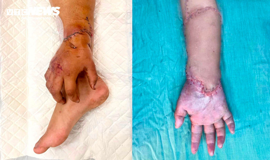 Bàn tay đứt lìa của mẹ bầu được nối lại sau thời gian 'nuôi' ở chân