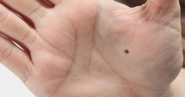 4 vị trí nốt ruồi phú quý, ai sở hữu đều có cuộc đời giàu sang, phúc lộc đủ đầy