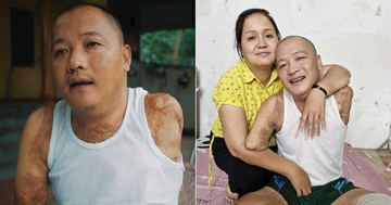 Mất 2 tay 1 chân sau tai nạn, người đàn ông tìm lại cuộc đời nhờ tình yêu của vợ