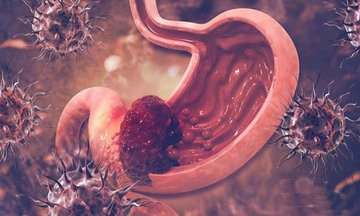 Không phải tự nhiên bị ung thư dạ dày! Nghiên cứu phát hiện người mắc bệnh liên quan đến 5 điều sau!