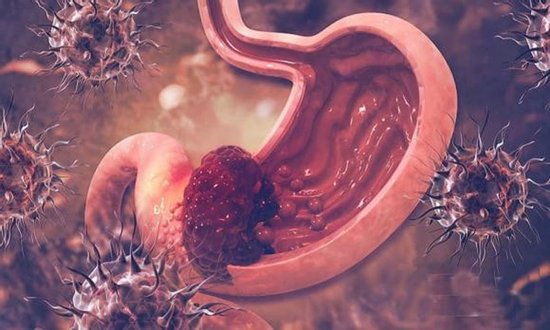 Không phải tự nhiên bị ung thư dạ dày! Nghiên cứu phát hiện người mắc bệnh liên quan đến 5 điều sau!