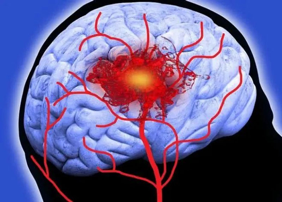 Đột quỵ dễ xảy ra hơn trong thời gian này! Làm 8 điều trong mùa đông để giảm nguy cơ