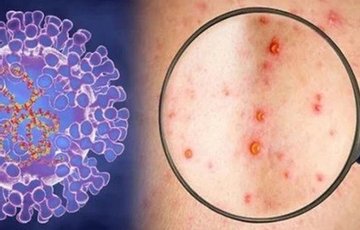 Xuất hiện ca bệnh đậu mùa khỉ chưa rõ nguồn lây ở Đồng Nai