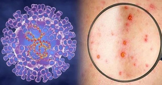 Xuất hiện ca bệnh đậu mùa khỉ chưa rõ nguồn lây ở Đồng Nai