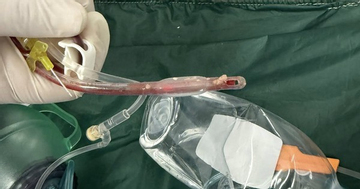 Bác sĩ cấp cứu đau lòng trước bé gái 3 tuổi sặc thức ăn ở nhà trẻ