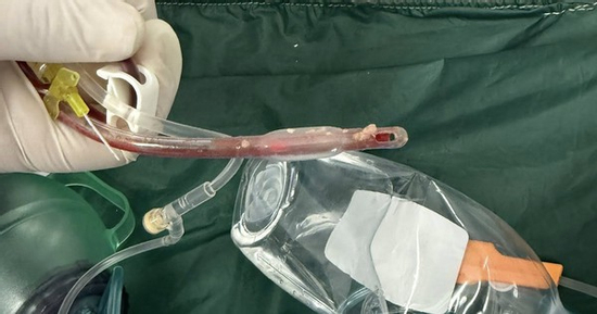 Bác sĩ cấp cứu đau lòng trước bé gái 3 tuổi sặc thức ăn ở nhà trẻ