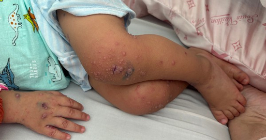 Nhiều trẻ mắc tay chân miệng trở nặng do tác nhân EV71, bác sĩ khuyến cáo gì?