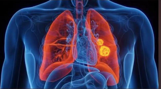 Nhiều người thường bỏ qua những dấu hiệu đầu tiên của ung thư phổi