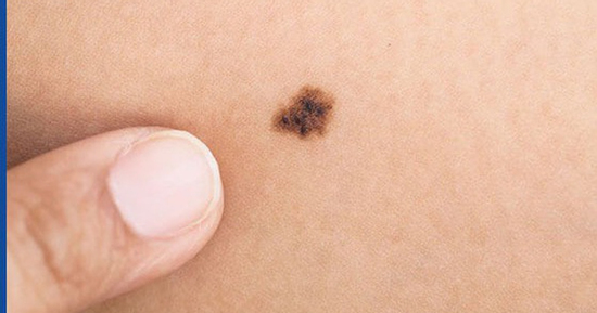 Sở hữu nốt ruồi ở những vị trí này, cuộc sống viên mãn, tình tiền hanh thông