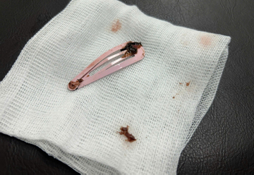 Gắp kẹp tóc dài 7cm khỏi dạ dày bé gái 6 tuổi