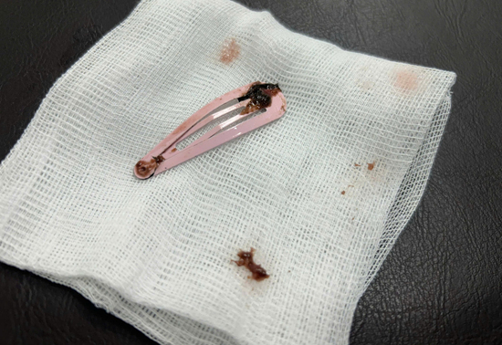 Gắp kẹp tóc dài 7cm khỏi dạ dày bé gái 6 tuổi