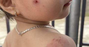 Nhà trường báo cáo gì về vụ bé gái 2 tuổi bị nhiều vết cắn khi học ở lớp?