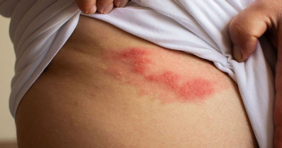 Đáng sợ cơn đau dai dẳng sau khỏi bệnh “giời leo”