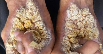 Người đàn ông thứ hai tại Việt Nam mắc hội chứng “người cây”