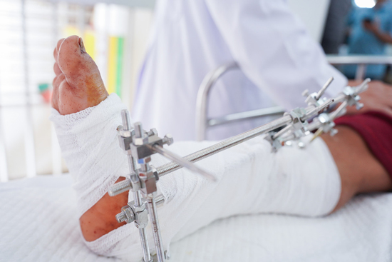 Nối thành công bàn chân của 2 nạn nhân bị máy cắt cỏ chém đứt lìa