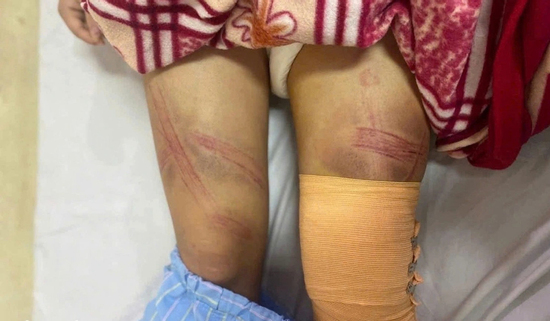 Nữ sinh lớp 7 ở Nghệ An nhập viện nghi do bị bố bạo hành