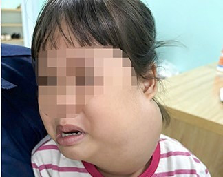 48 giờ sinh tử của bé gái 2 tuổi có khối u khổng lồ