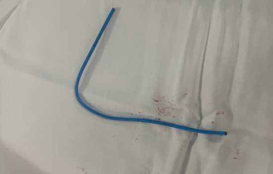 Ống thông truyền hóa chất bị bỏ quên suốt 3 năm, đứt trôi vào tim người phụ nữ