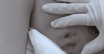 Cô gái nhập viện vì áp xe nặng sau tiêm filler nâng vòng một