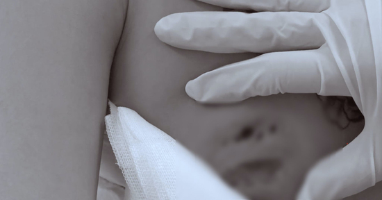 Cô gái nhập viện vì áp xe nặng sau tiêm filler nâng vòng một