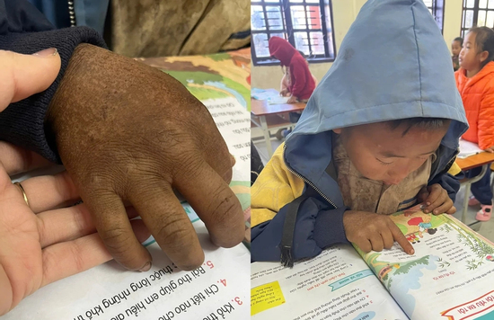 Hình ảnh bàn tay nứt nẻ của cậu bé 8 tuổi vùng cao khiến triệu người nghẹn lại