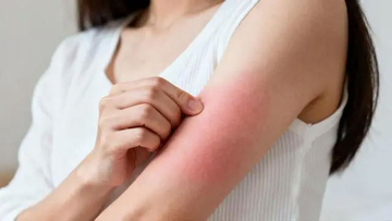 Bác sĩ: Bệnh thận giai đoạn đầu không biểu hiện bằng phù nề mà chỉ có 3 bất thường chính