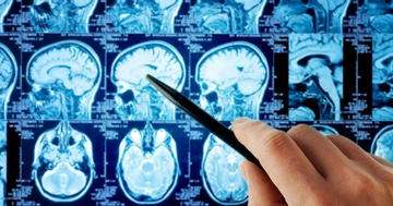 Trẻ 8 tuổi đã bị đột quỵ, dấu hiệu dễ nhầm lẫn với cảm cúm