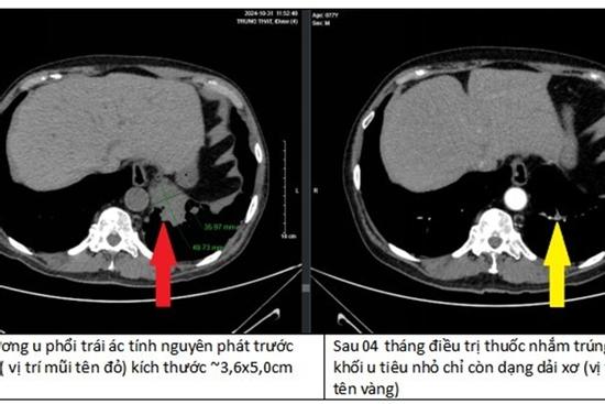 Người đàn ông Hà Nội mắc ung thư giai đoạn cuối: Sau 4 tháng làm 1 điều, 90% khối u đã biến mất