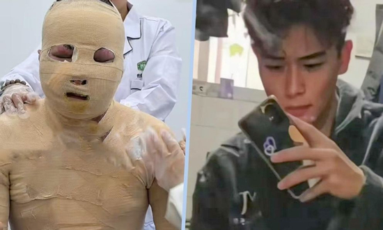 Chàng trai khôi ngô bị bỏng 90% do xe đạp điện nổ khi sạc, bạn cùng phòng có hành động phẫn nộ
