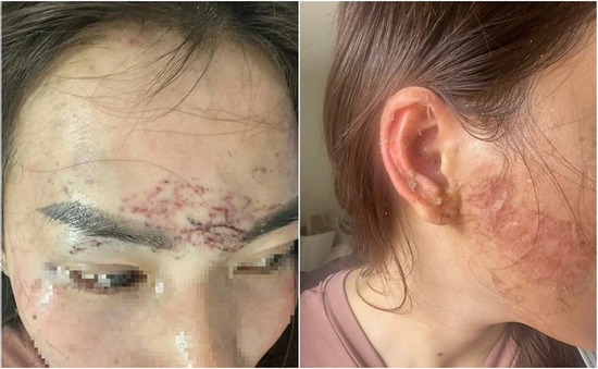 Một phụ nữ ở Cà Mau tố bị xăm mặt, cắt tóc... vì ghen