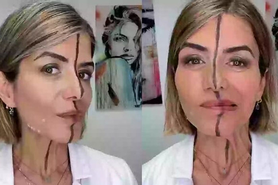 Nữ bác sĩ tiêm botox nửa khuôn mặt để chứng minh tác hại của cách làm đẹp này