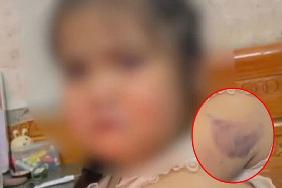 Học sinh lớp 1 nghi bị cô giáo đánh bầm tím tay vì viết chữ xấu