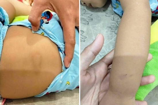 Bé 2 tuổi bị 